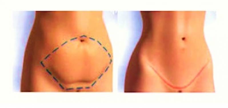 Abdominoplastia Barriga Inchada Jockey Club - Abdominoplastia em âncora