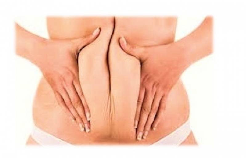 Abdominoplastia Cirurgia Preço Perdizes - Abdominoplastia em âncora