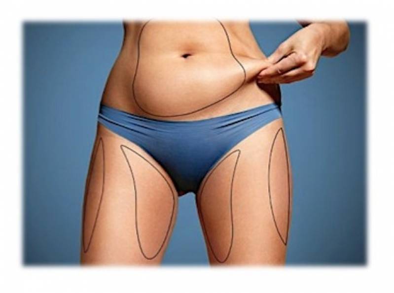 Abdominoplastia Cirurgia Valor Saúde - Abdominoplastia Barriga Inchada