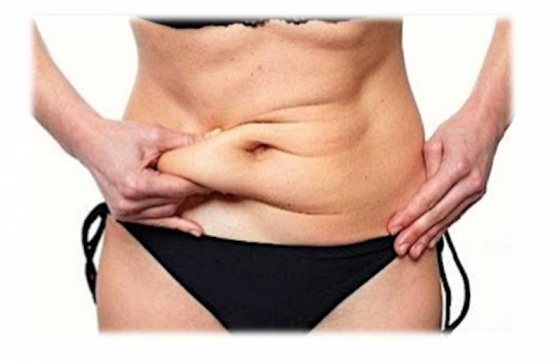 Abdominoplastia com Lipo Preço São Caetano do Sul - Abdominoplastia Pós-emagrecimento