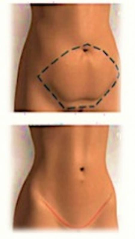 Abdominoplastia com Lipo Jardim Europa - Abdominoplastia Barriga Inchada