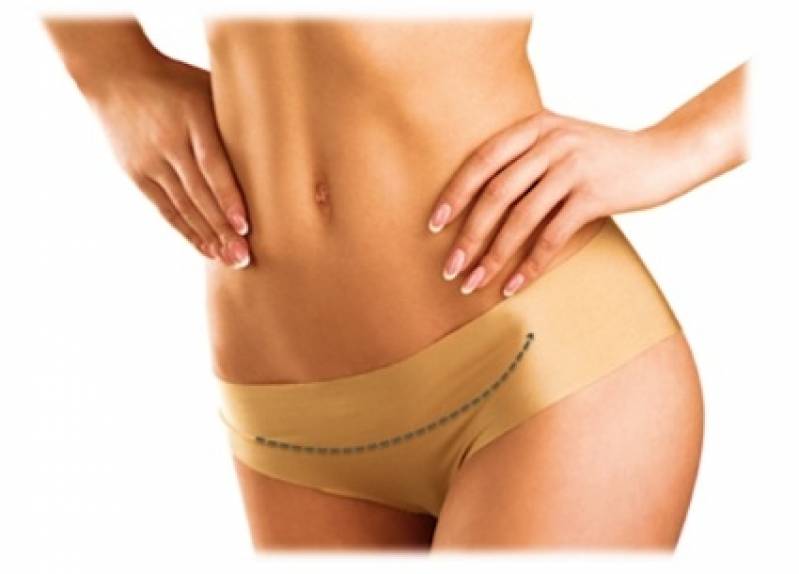 Abdominoplastia com Lipoescultura Preço São Bernardo do Campo - Abdominoplastia para Ex Obesos