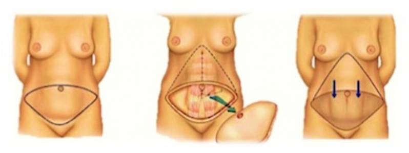 Abdominoplastia com Lipoescultura Vila Mariana - Abdominoplastia em âncora