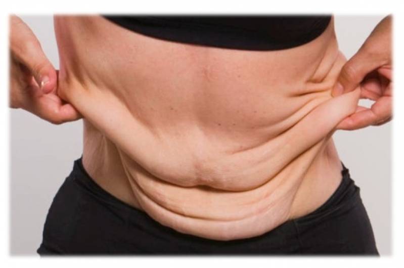 Abdominoplastia em âncora Cidade Jardim - Abdominoplastia Masculina