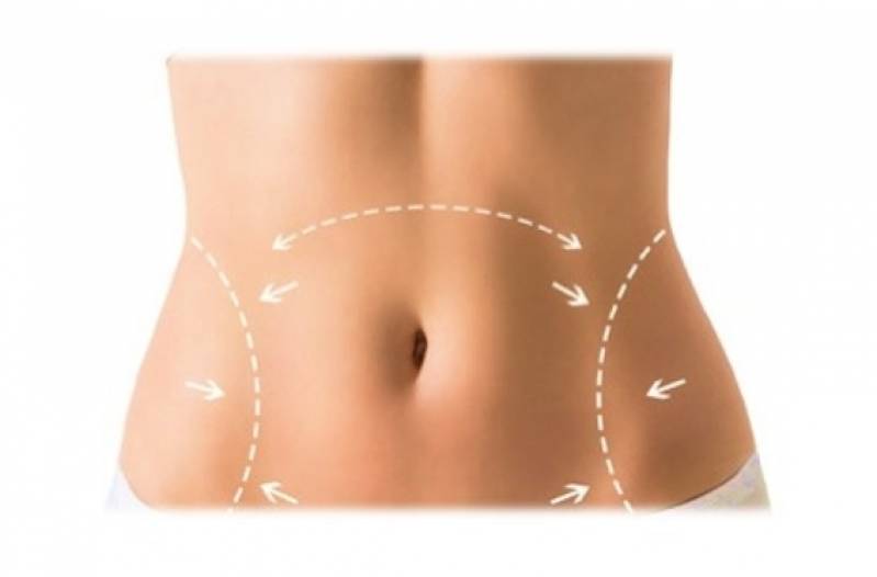 Abdominoplastia para Barriga de Avental Preço Ipiranga - Abdominoplastia Barriga Estufada