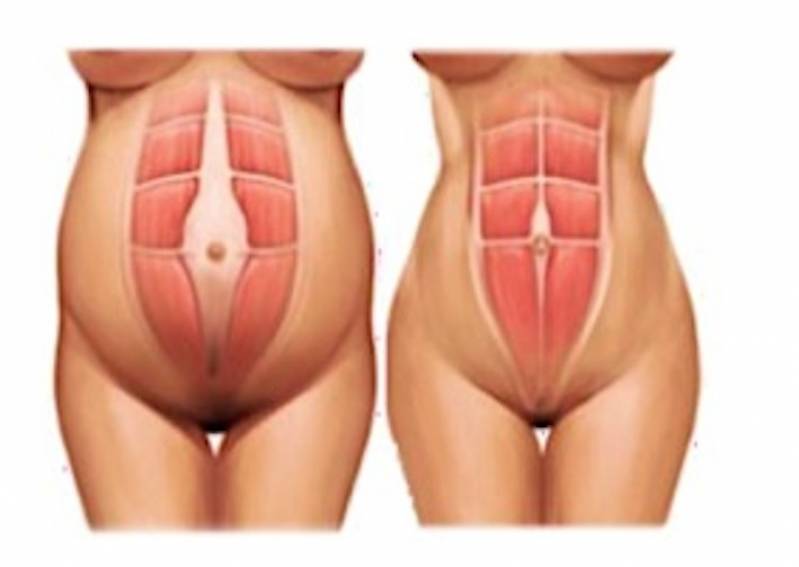 Abdominoplastia para Diabéticos Cidade Jardim - Abdominoplastia em âncora