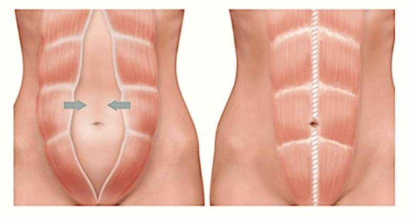 Abdominoplastia para Retirar Estrias Saúde - Abdominoplastia em âncora