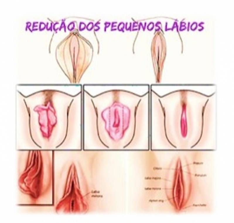 Cirurgia Intima de Labioplastia Diadema - Cirurgia íntima Feminina