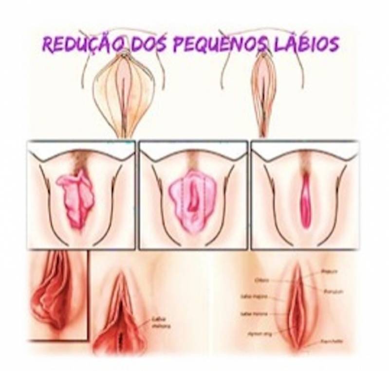 Cirurgia Intima de Labioplastia Saúde - Cirurgia Redução Lábios Vaginais