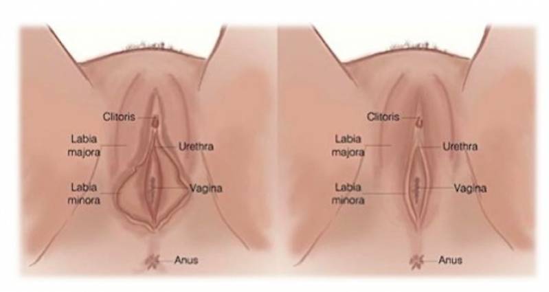 Cirurgia íntima Feminina Jardim Morumbi - Cirurgia nos Lábios íntimos