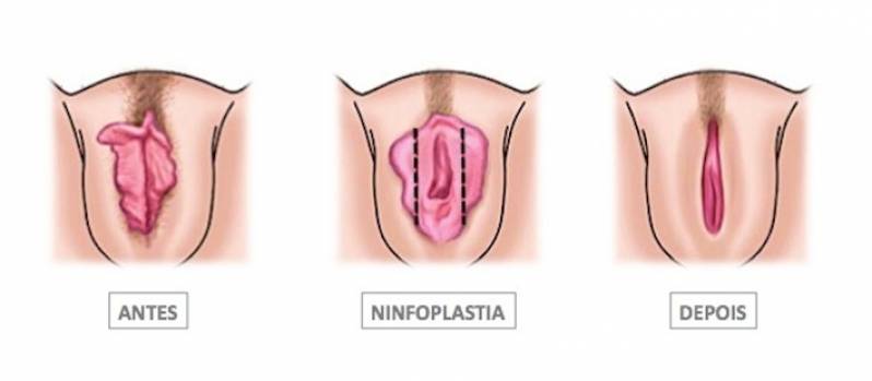 Cirurgia íntima nos Pequenos Lábios Diadema - Ninfoplastia