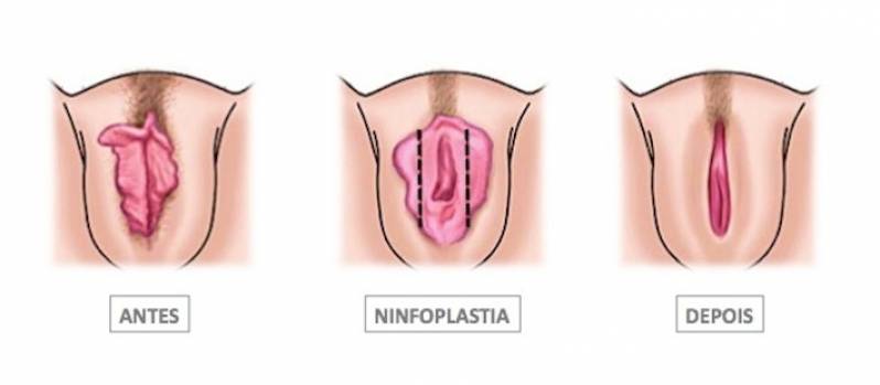 Cirurgia íntima nos Pequenos Lábios Vila Maria - Cirurgia Intima de Labioplastia