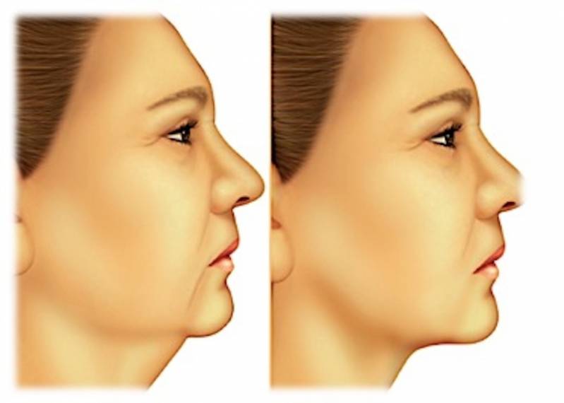 Cirurgia Plástica de Papada Preço Brooklin - Cirurgia Plástica de Rosto