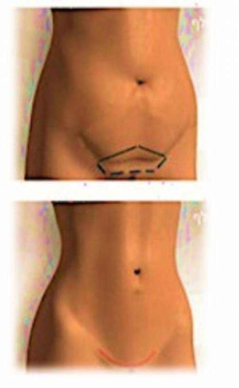 Cirurgia Plástica no Abdômen Moema - Cirurgia Plástica de Papada