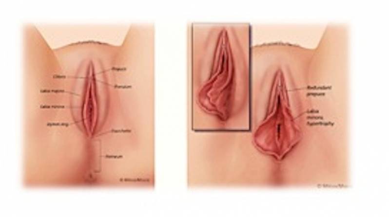 Cirurgia Plástica nos Pequenos Lábios Vila Morumbi - Cirurgia para Lábios Vaginais