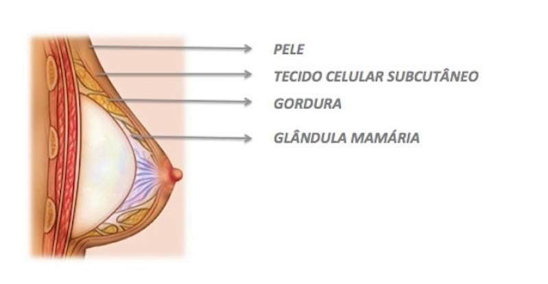 Cirurgia Prótese Mamas Preço Morumbi - Prótese de Silicone