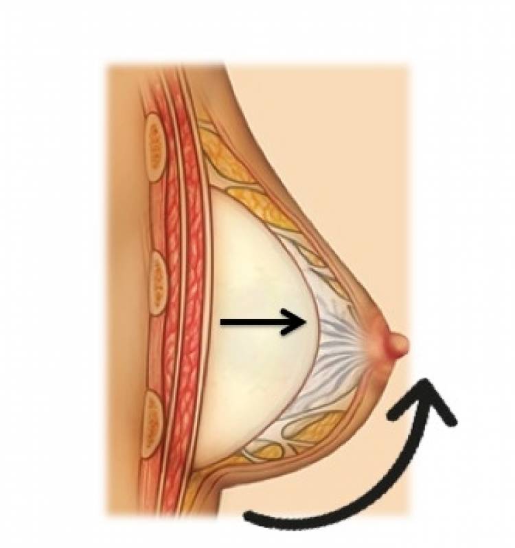 Cirurgia Prótese Mamas Valor Brooklin - Prótese de Silicone