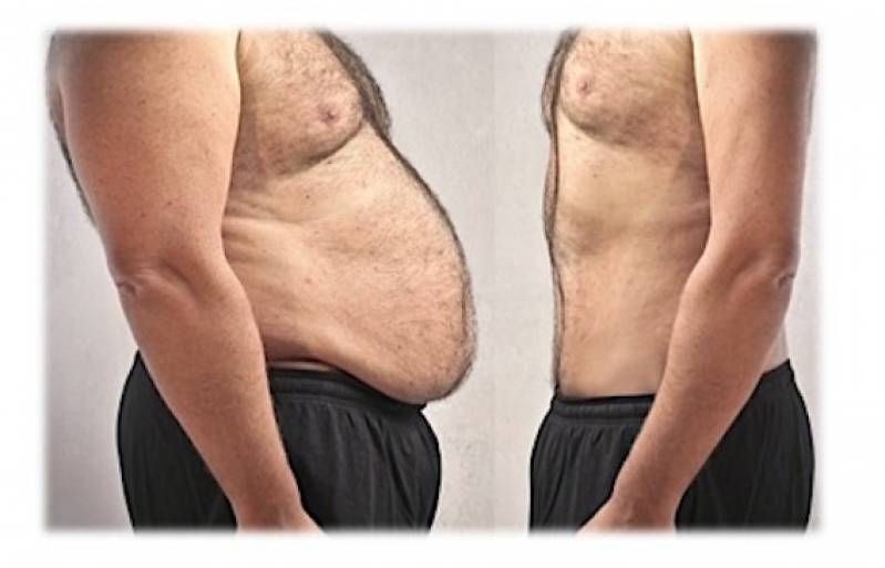 Clínica de Abdominoplastia Masculina Ipiranga - Abdominoplastia Pós-cirurgia Bariátrica