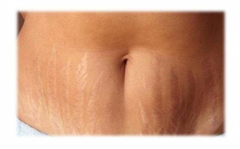 Clínica de Abdominoplastia para Retirar Estrias Tatuapé - Abdominoplastia Barriga Estufada