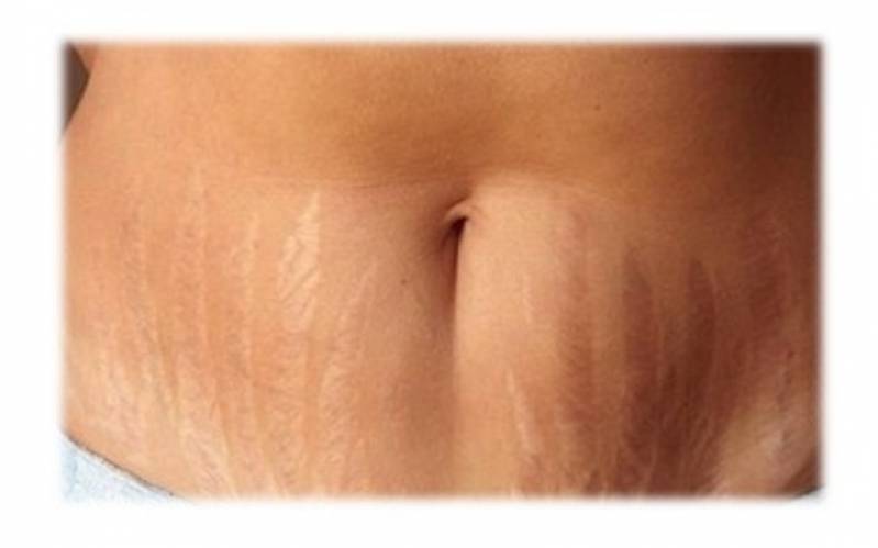 Clínica de Abdominoplastia para Retirar Estrias Morumbi - Abdominoplastia em âncora