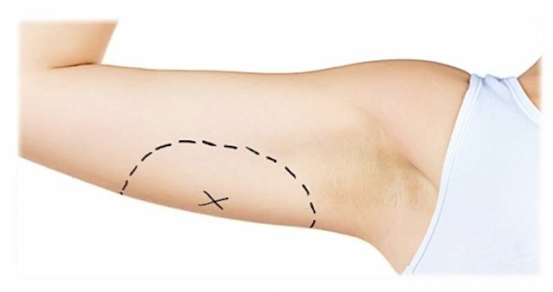 Clínica de Lipoaspiração de Braço Jardim Europa - Lipoaspiração para Gordura Localizada