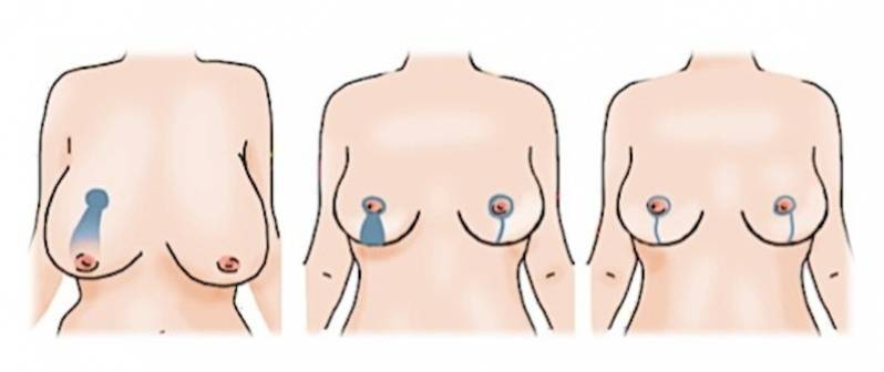 Clínica de Mamoplastia Corretiva Jardins - Mamoplastia Redutora de Pele