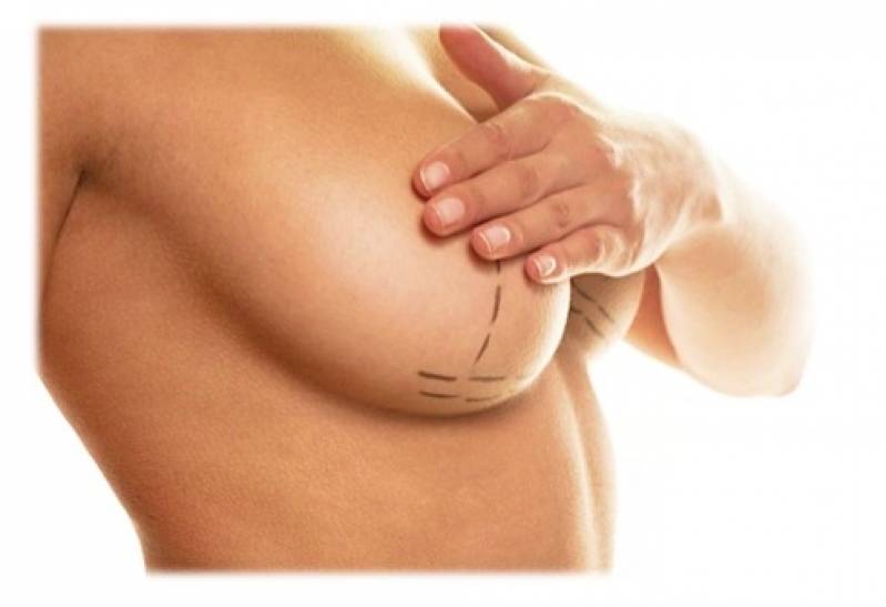Clínica de Mamoplastia Redutora de Pele Perdizes - Mamoplastia com Prótese