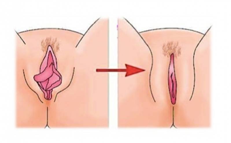 Labioplastia Feminina Vila Morumbi - Cirurgia Intima de Labioplastia