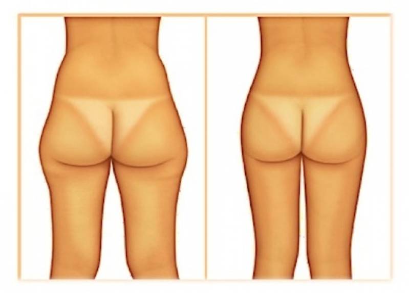 Lipoaspiração para Culote Preço Pinheiros - Lipoaspiração para Afinar a Cintura