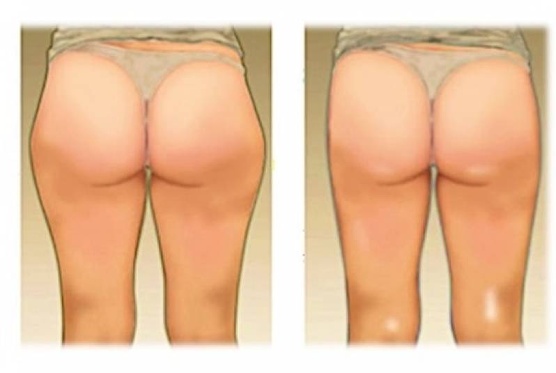 Lipoaspiração para Culote Valor Diadema - Lipoaspiração para Axilas