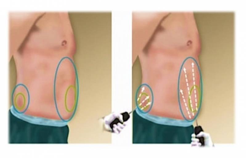 Lipoaspiração para Homens Preço Pinheiros - Lipoaspiração para Gordura Localizada