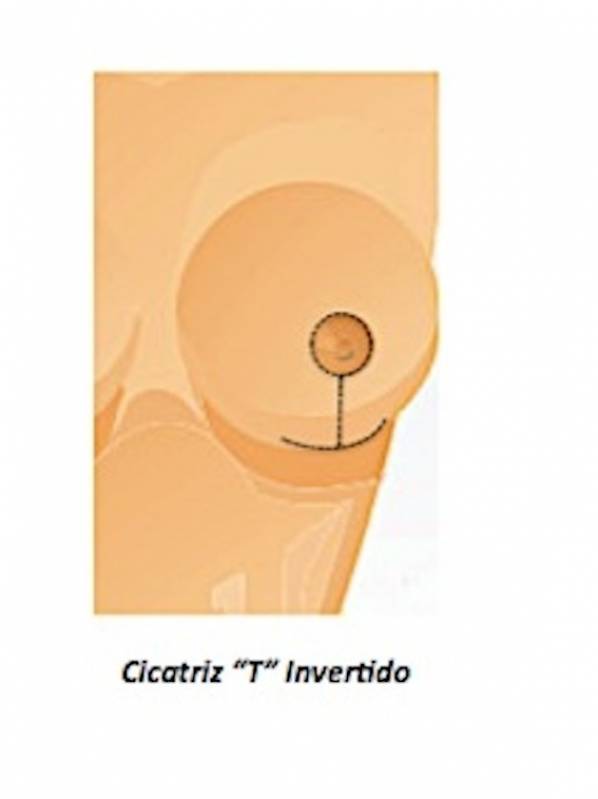 Mamoplastia após Amamentação Cidade Jardim - Mamoplastia Redutora Levantamento