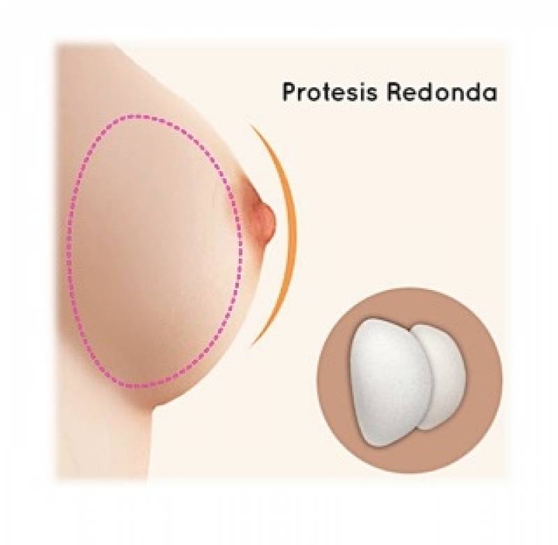 Mamoplastia Redutora com Prótese Preço Santana - Mamoplastia Redutora de Pele