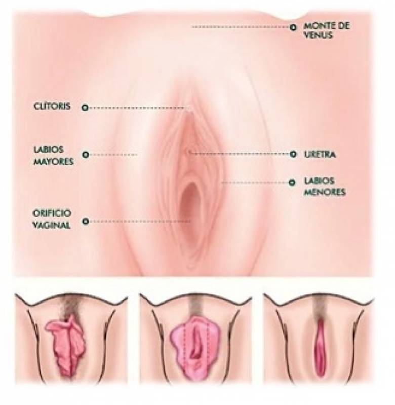 Ninfoplastia Jockey Club - Cirurgia Intima de Labioplastia