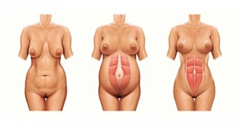 Onde Encontro Abdominoplastia Barriga Estufada Vila Mariana - Abdominoplastia para Diabéticos