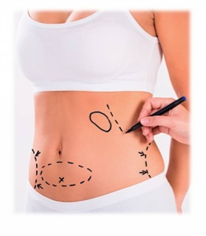 Onde Encontro Abdominoplastia Barriga Inchada Jardim Morumbi - Abdominoplastia em âncora