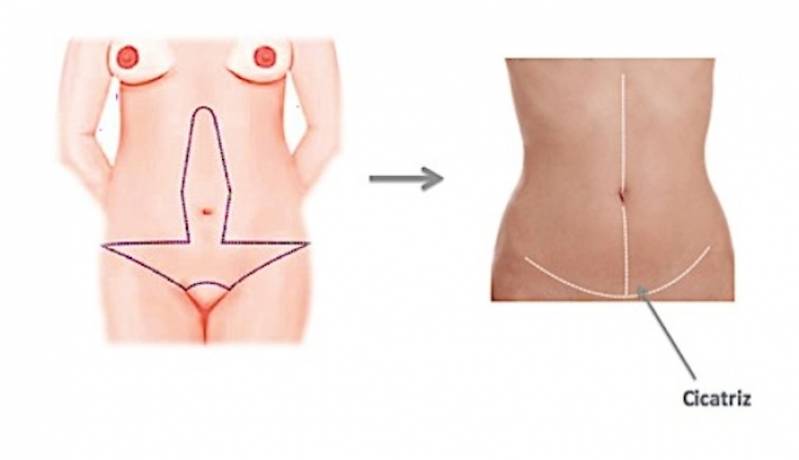 Onde Encontro Abdominoplastia em âncora Tatuapé - Abdominoplastia com Lipoescultura