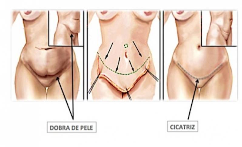 Onde Encontro Abdominoplastia para Barriga de Avental Cidade Jardim - Abdominoplastia com Lipo