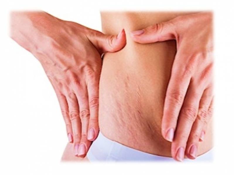 Onde Encontro Abdominoplastia para Retirar Estrias Perdizes - Abdominoplastia com Lipo