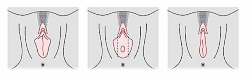 Onde Encontro Cirurgia íntima nos Pequenos Lábios Moema - Cirurgia de Labioplastia