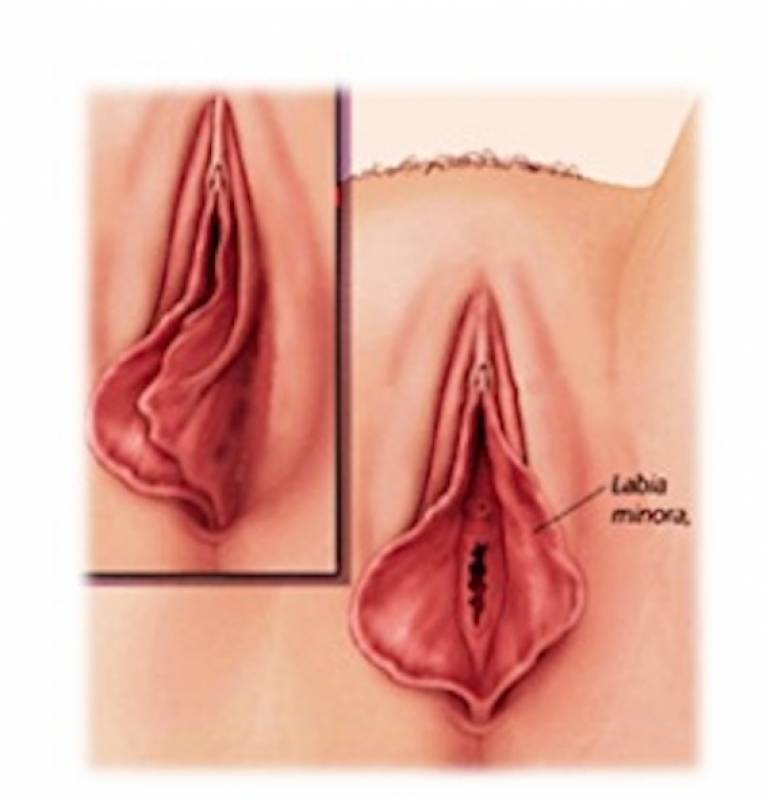 Onde Encontro Cirurgia nos Lábios íntimos Santo André - Cirurgia Plástica nos Pequenos Lábios