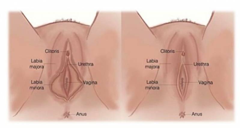 Onde Encontro Cirurgia Plástica nos Pequenos Lábios Saúde - Cirurgia Intima de Labioplastia