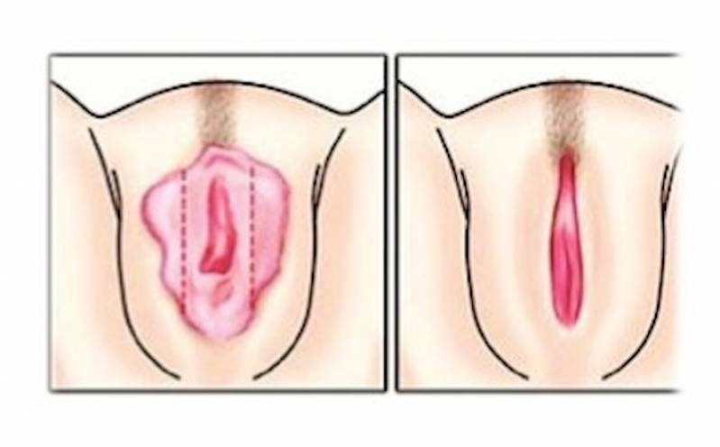 Onde Encontro Labioplastia Feminina Perdizes - Cirurgia para Lábios Vaginais