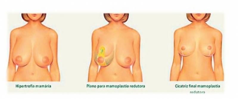 Onde Encontro Mamoplastia após Amamentação Moema - Mamoplastia Redutora de Mama