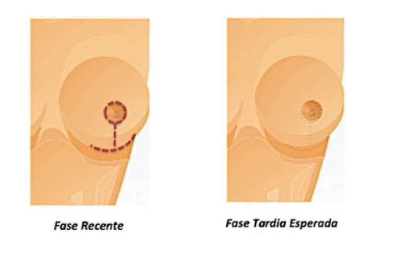 Onde Encontro Mamoplastia Bilateral Morumbi - Mamoplastia Redutora com Silicone