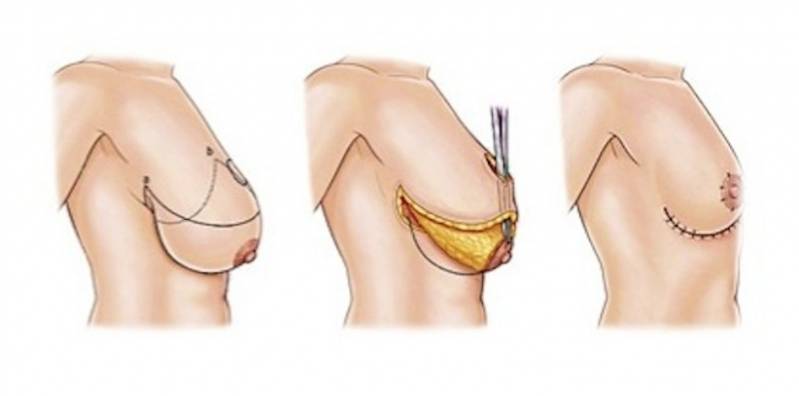 Onde Encontro Mamoplastia Corretiva Morumbi - Mamoplastia com Prótese