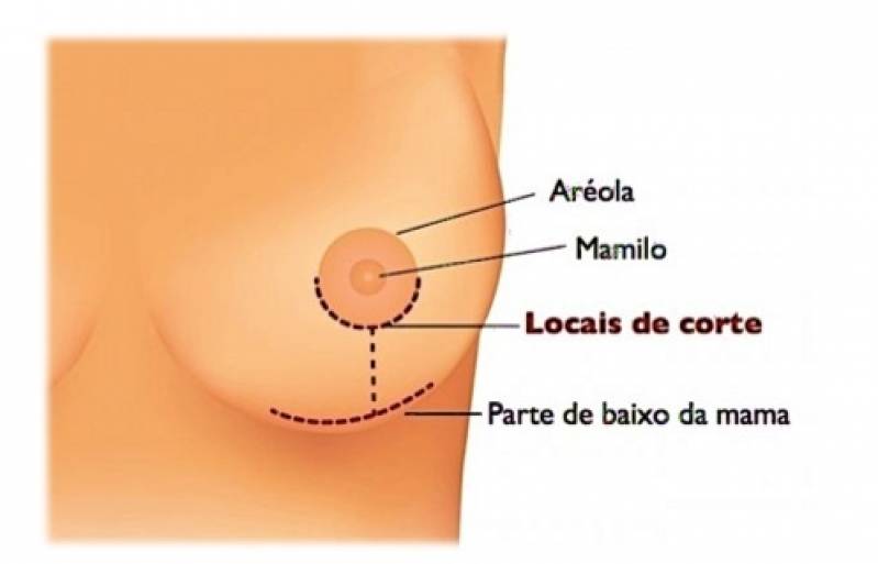 Onde Encontro Mamoplastia Redutora e Levantamento de Mama Perdizes - Mamoplastia após Amamentação