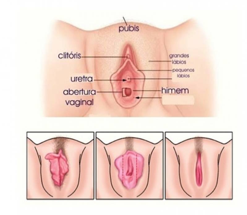 Onde Encontro Ninfoplastia Jardins - Cirurgia íntima nos Pequenos Lábios