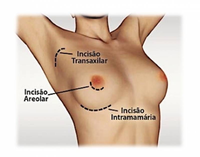 Prótese de Silicone Valor Santana - Prótese de Silicone e Mamoplastia