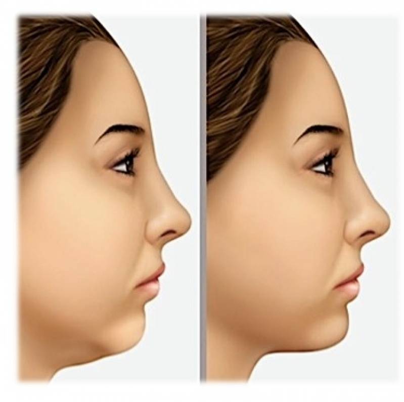 Quanto Custa Cirurgia Plástica de Papada Santana - Cirurgia Plástica Labial